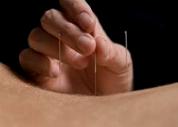 Acupuncture. BackNeedles